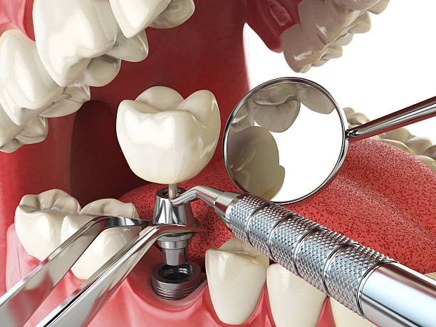 Best Knocked-Out Tooth (Avulsed Tooth) Treatment in South Brooksville, FL